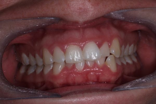 Pre-treatment