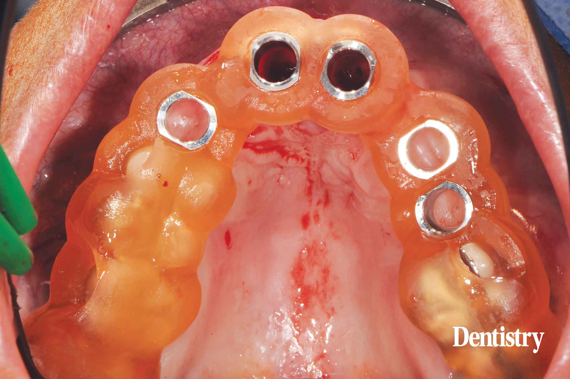 Digital workflow: a game changer for implant restoration