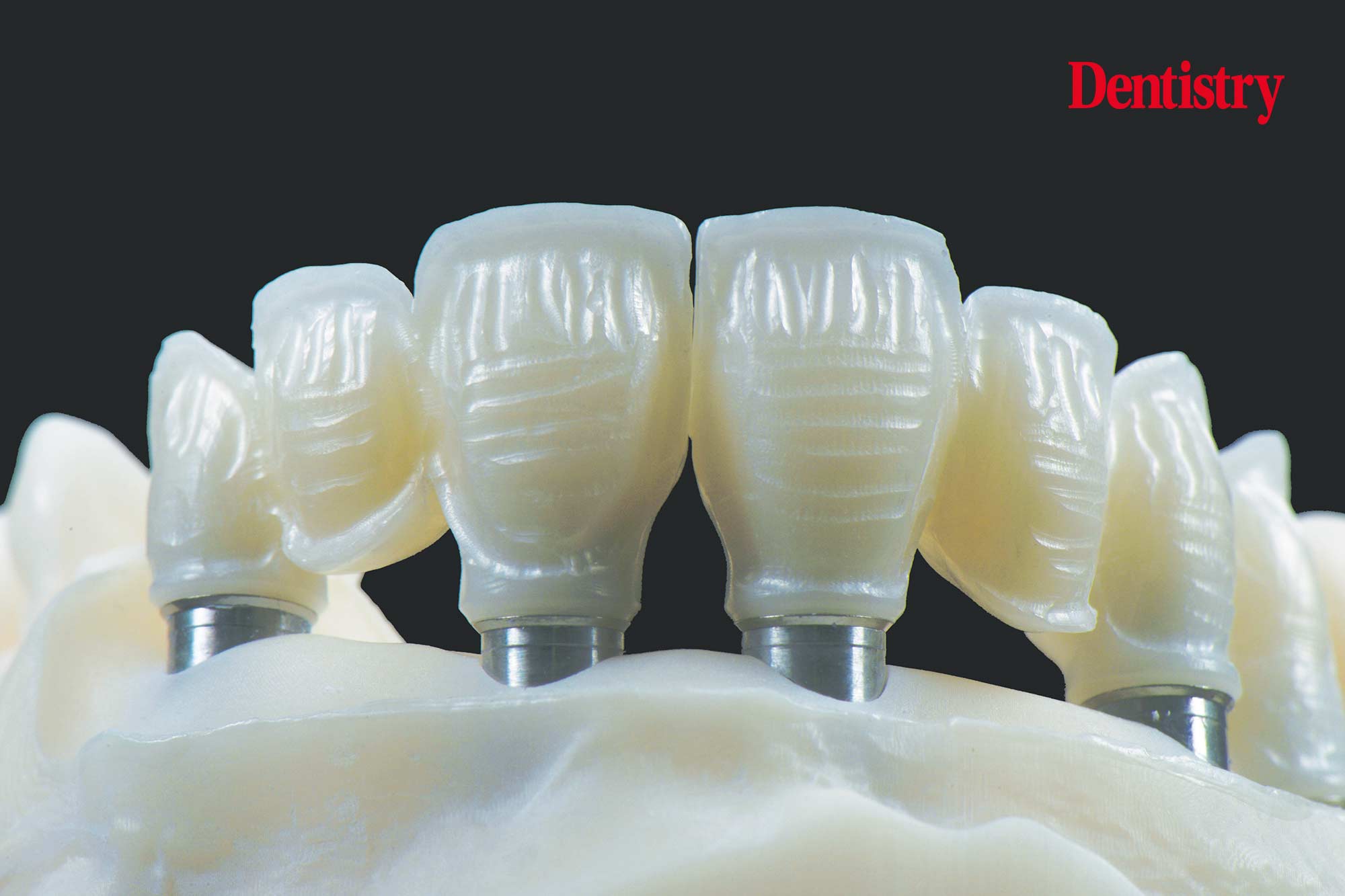 figure-59 Digital workflow: a game changer for implant restoration