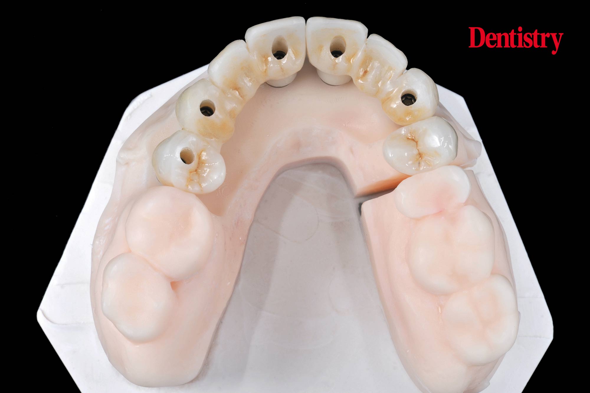 figure-60 Digital workflow: a game changer for implant restoration – part two
