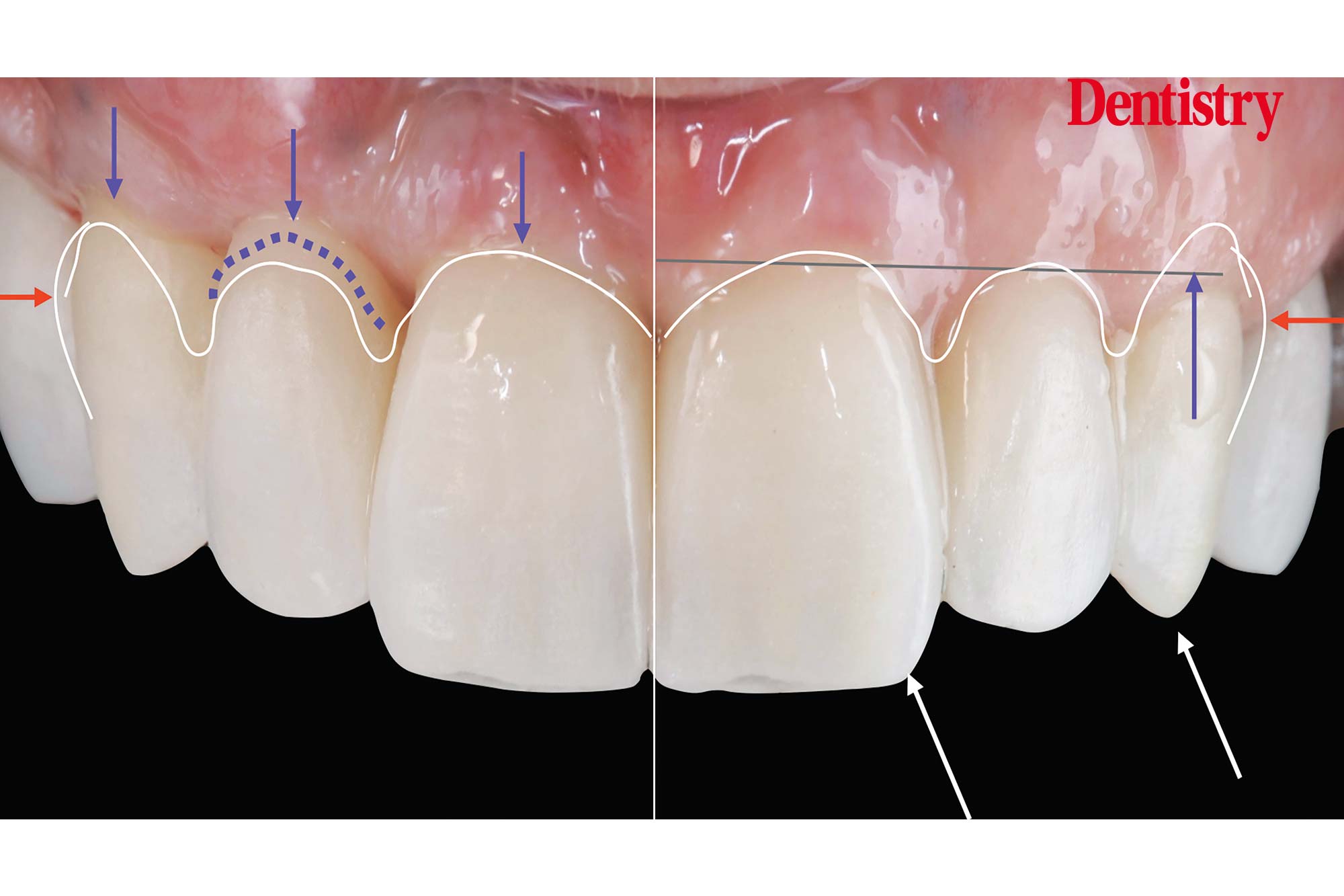 figure-65 Digital workflow: a game changer for implant restoration