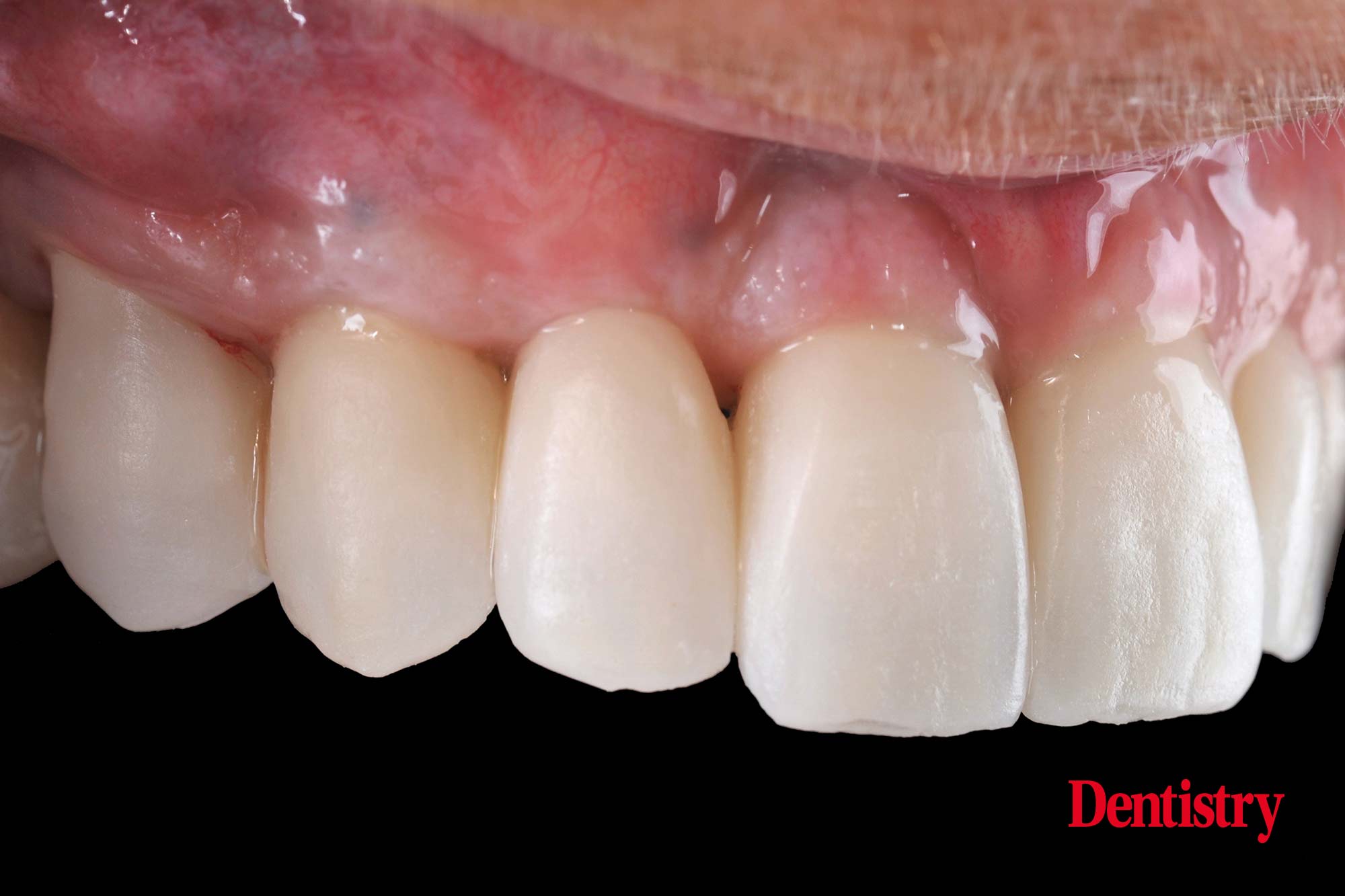 figure-66 Digital workflow: a game changer for implant restoration