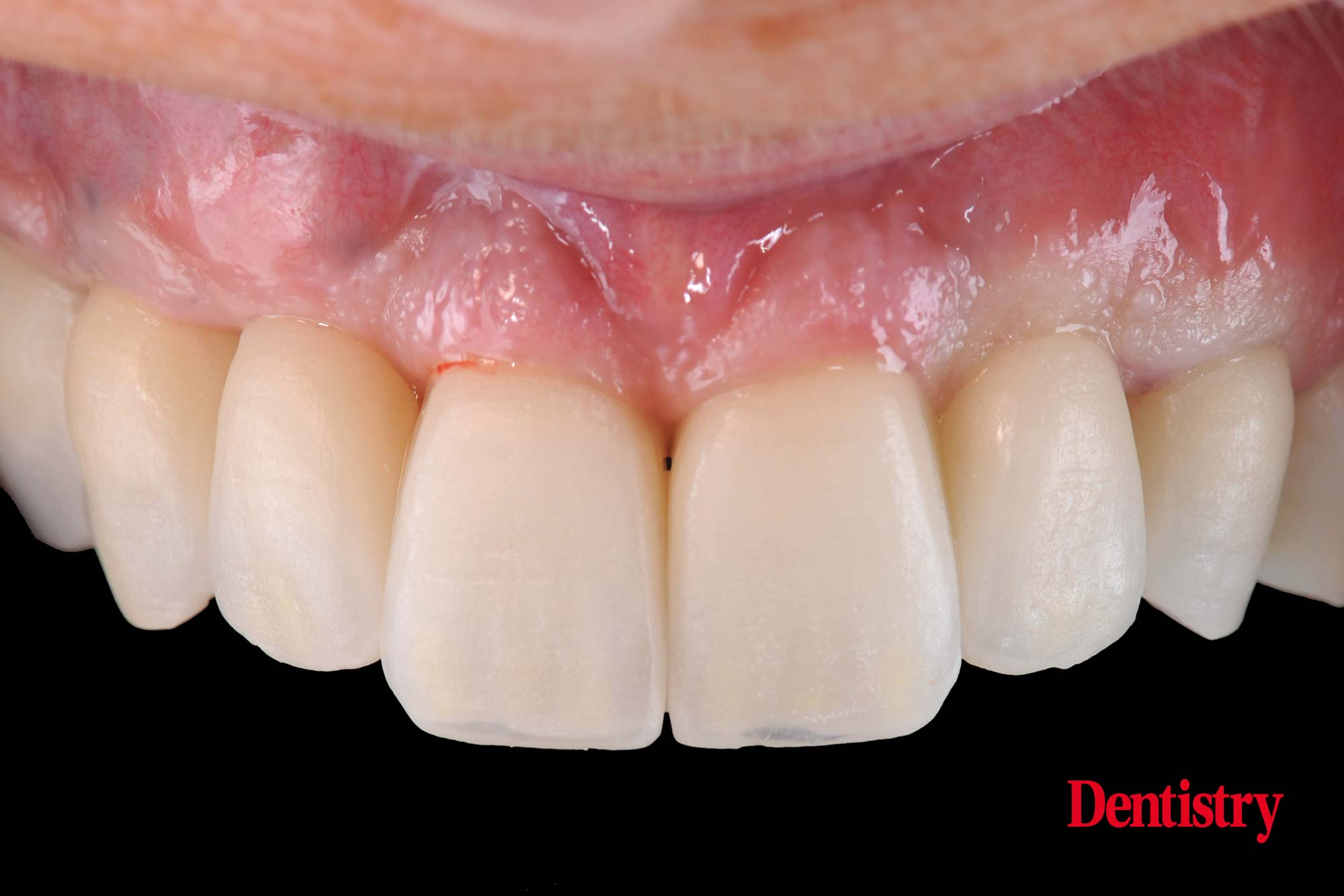 figure-67 Digital workflow: a game changer for implant restoration