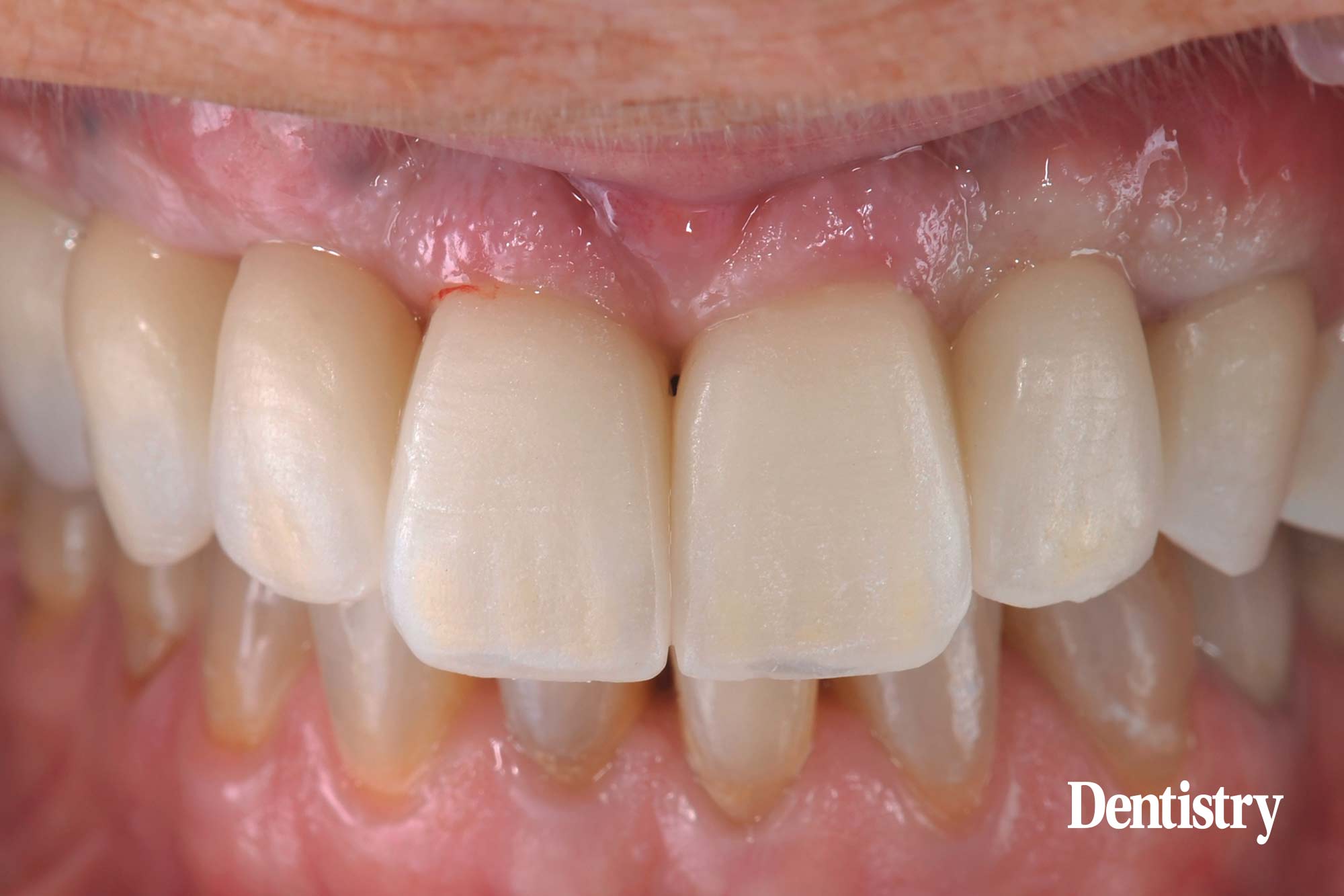 figure-68 Digital workflow: a game changer for implant restoration