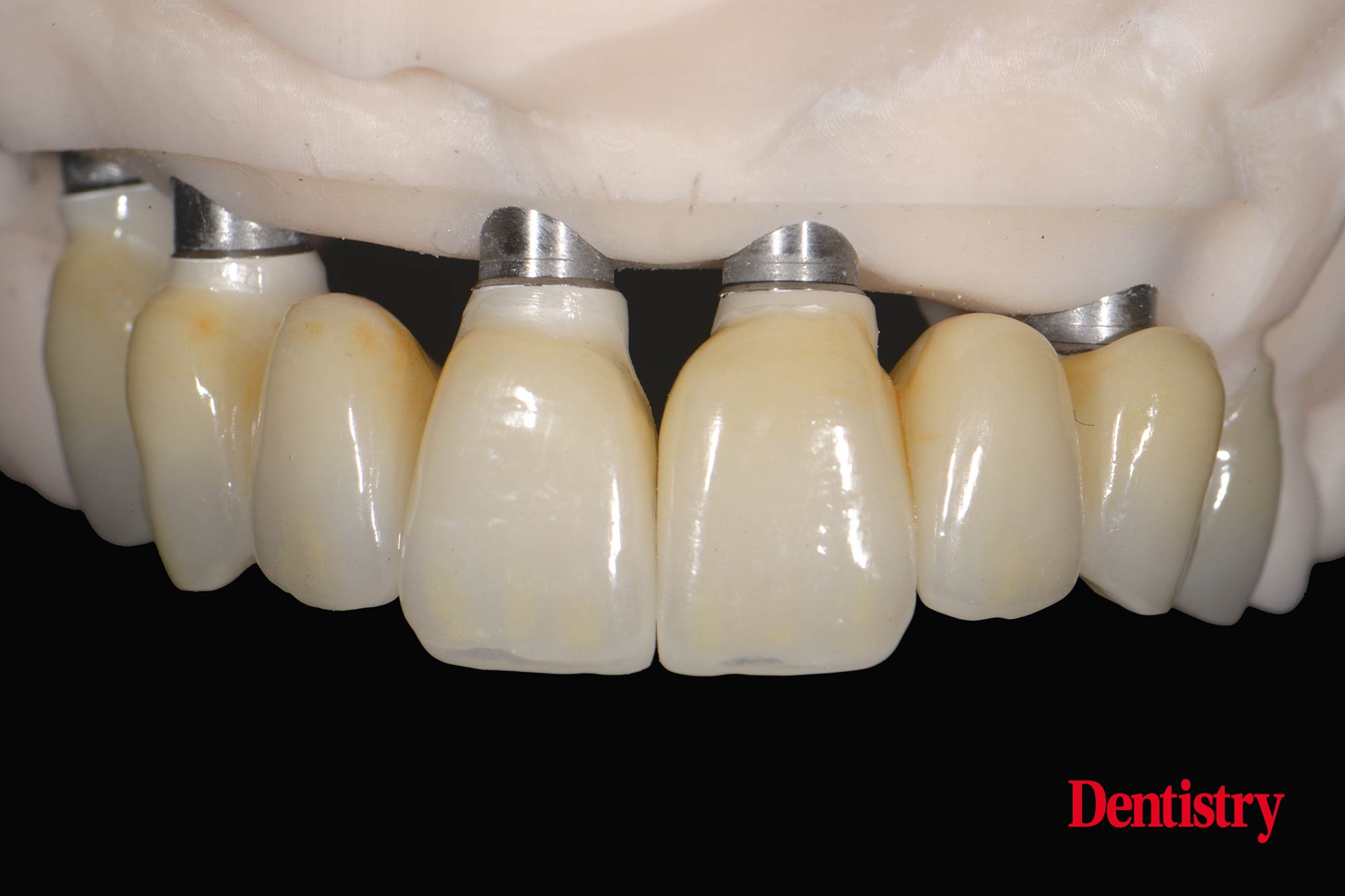 figure-70 Digital workflow: a game changer for implant restoration