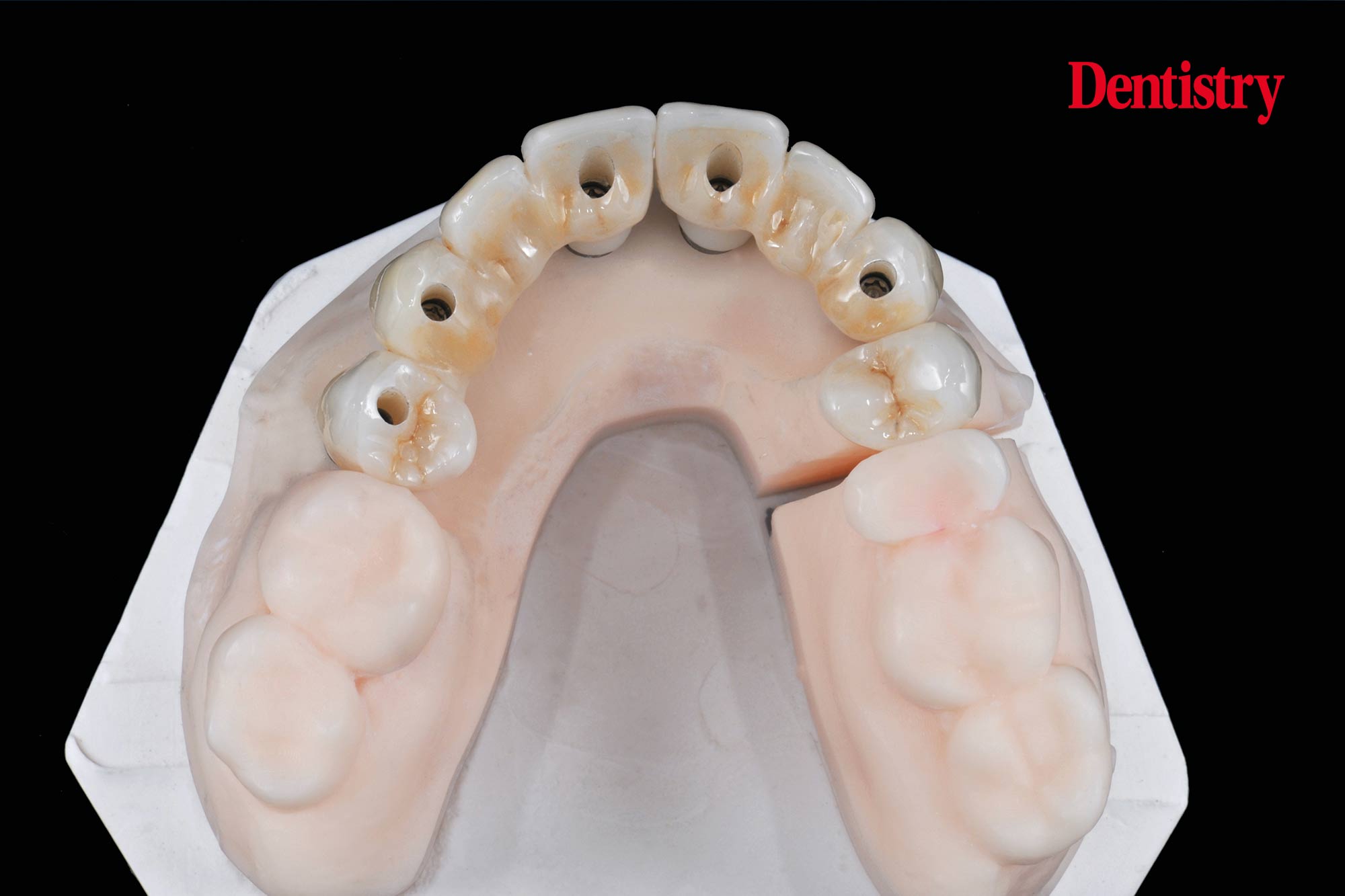 figure-71 Digital workflow: a game changer for implant restoration