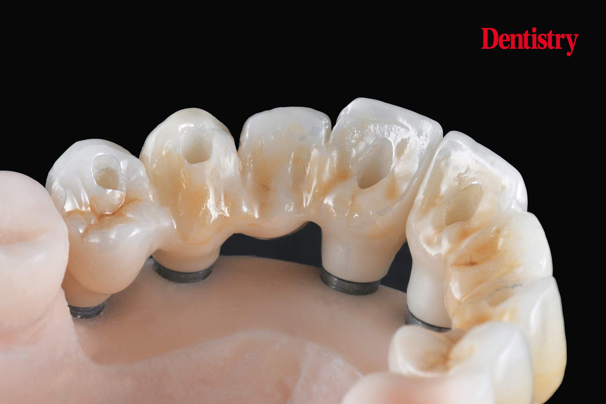 figure-72 Digital workflow: a game changer for implant restoration