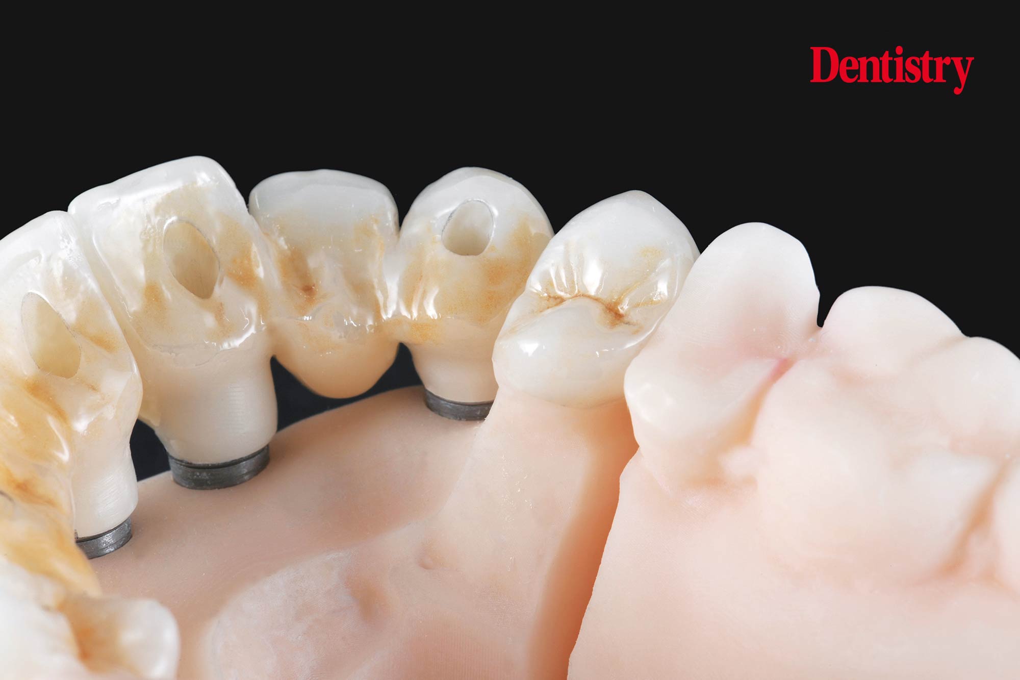 figure-73 Digital workflow: a game changer for implant restoration
