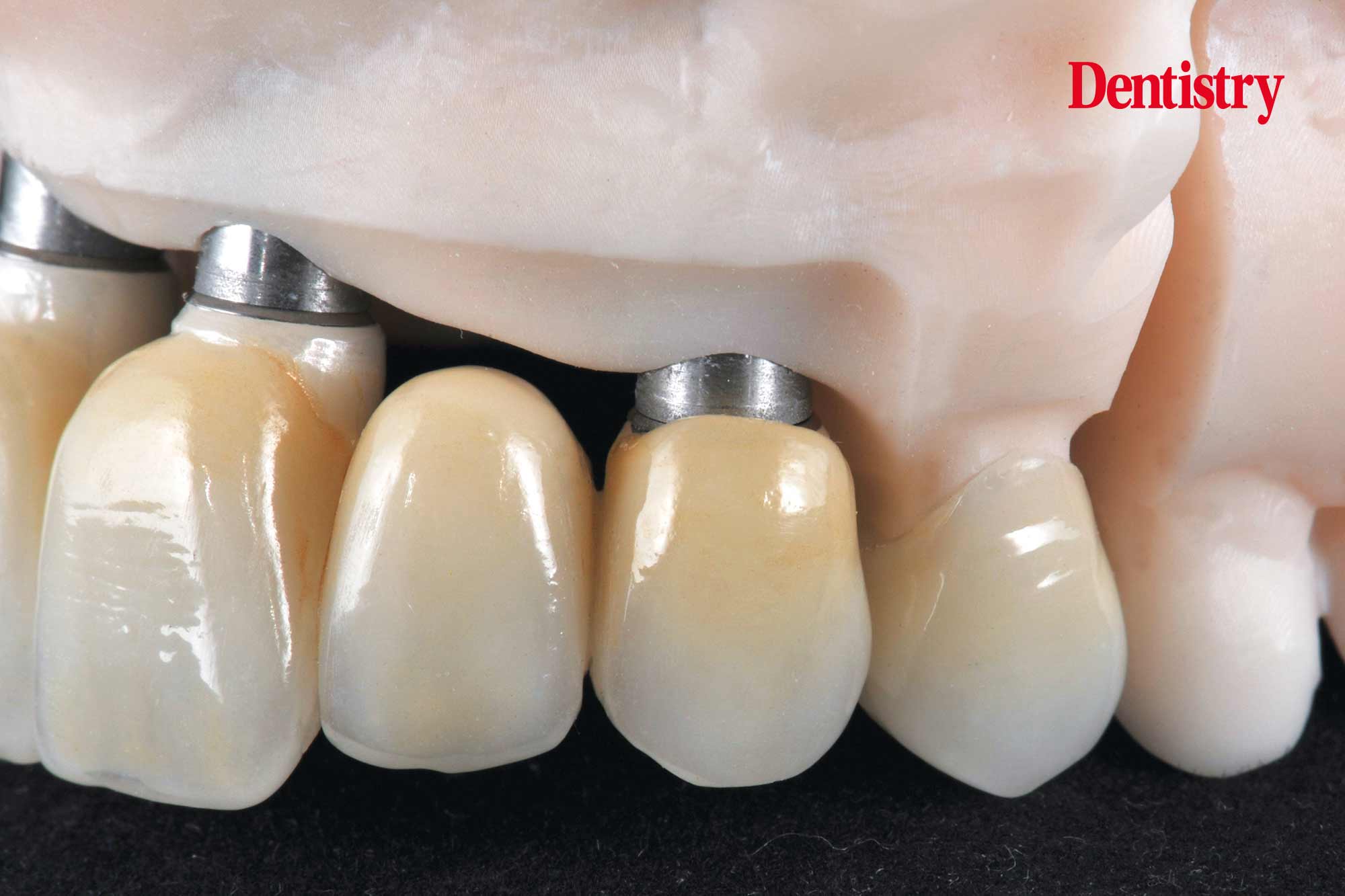 figure-74 Digital workflow: a game changer for implant restoration