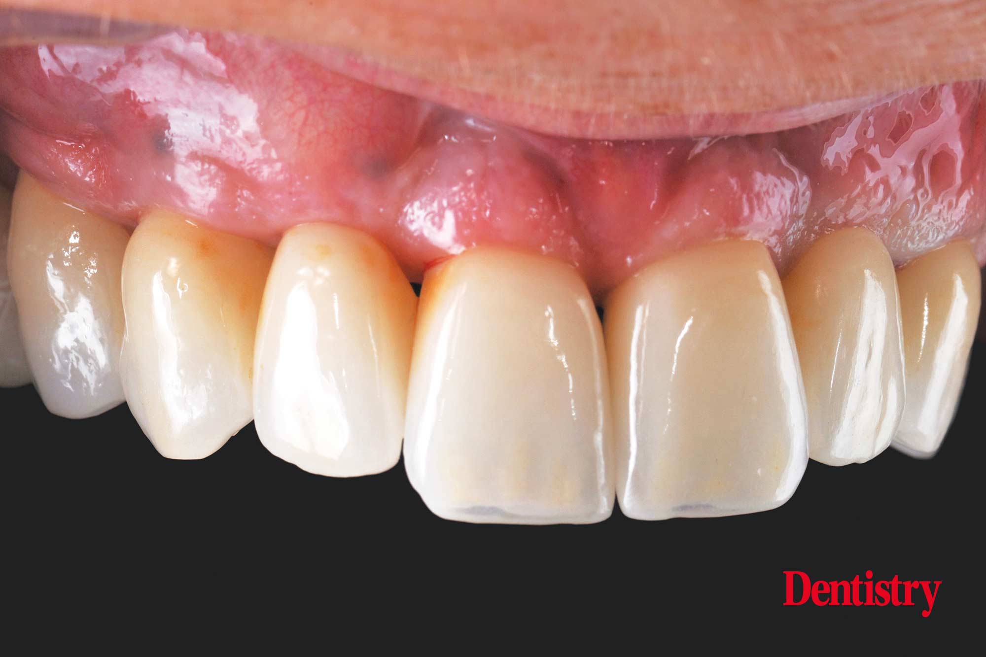 figure-76 Digital workflow: a game changer for implant restoration