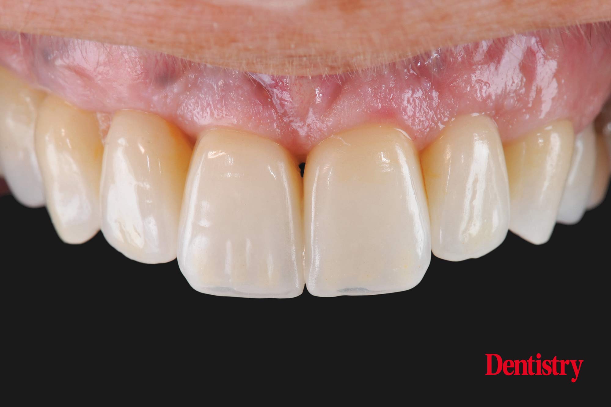 figure-77 Digital workflow: a game changer for implant restoration
