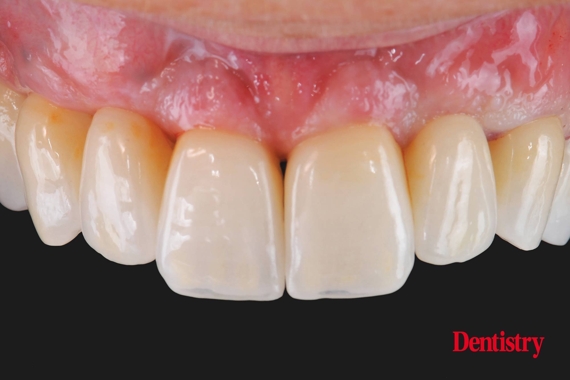 figure-78 Digital workflow: a game changer for implant restoration