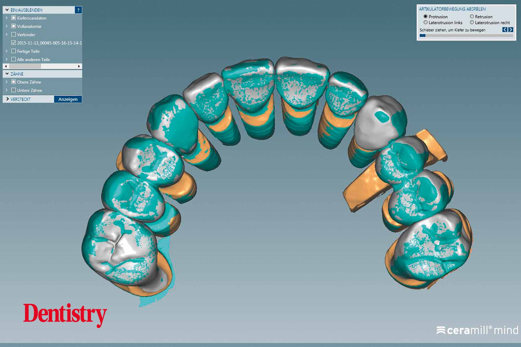 fig-17 Fabrication and cementation of crowns without chipping