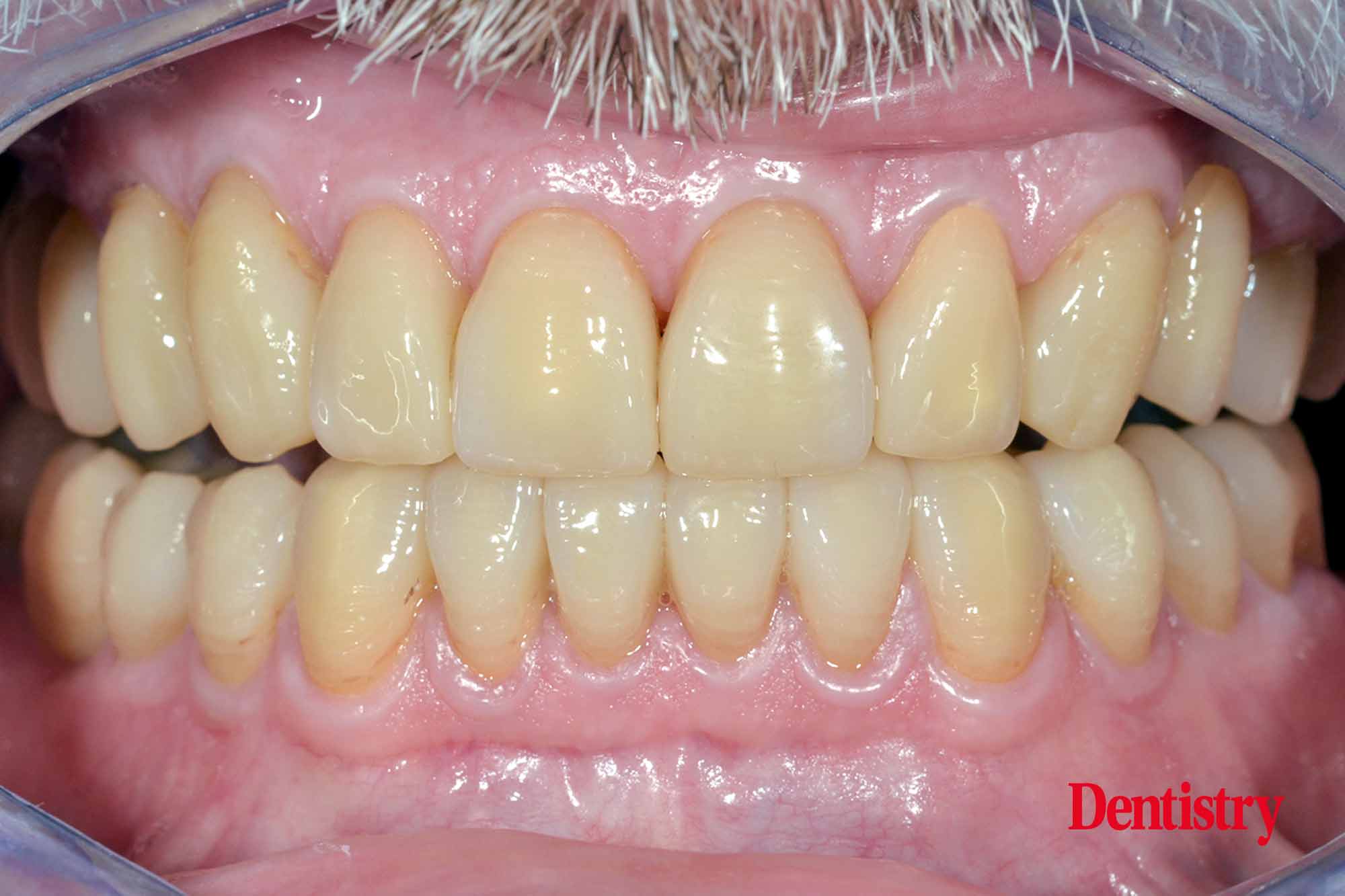 fig-25 Fabrication and cementation of crowns without chipping