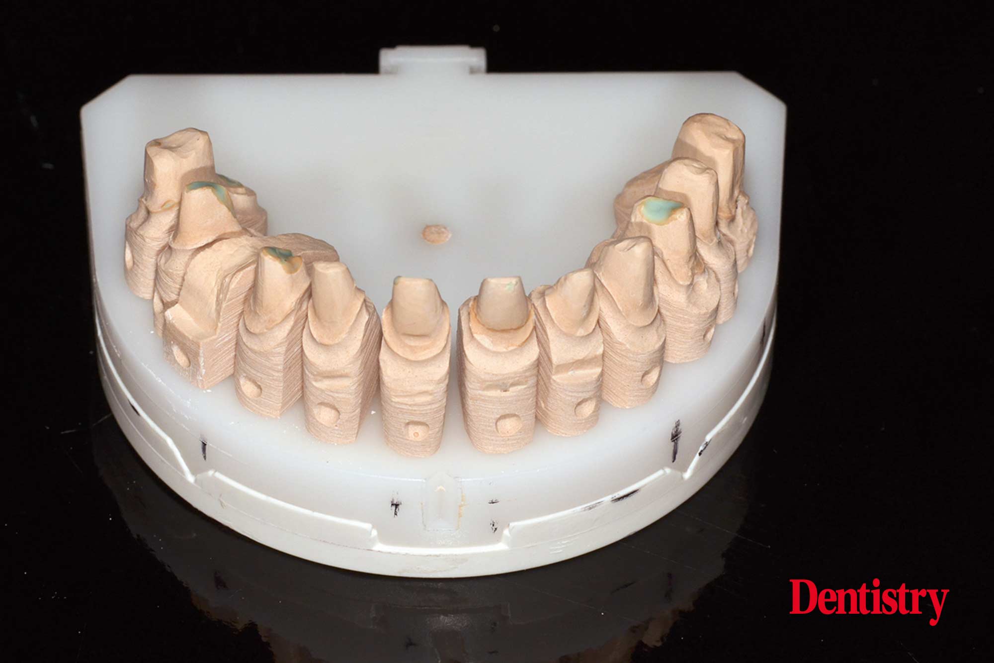 2a Fabrication and cementation of crowns without chipping