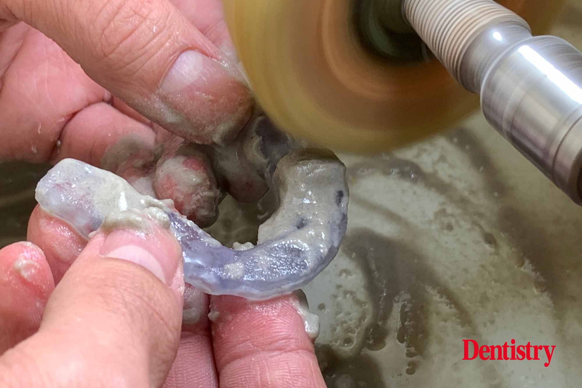 21 Andre Gaul RDT gives a step-by-step overview of the design and fabrication process of printed occlusal splints.