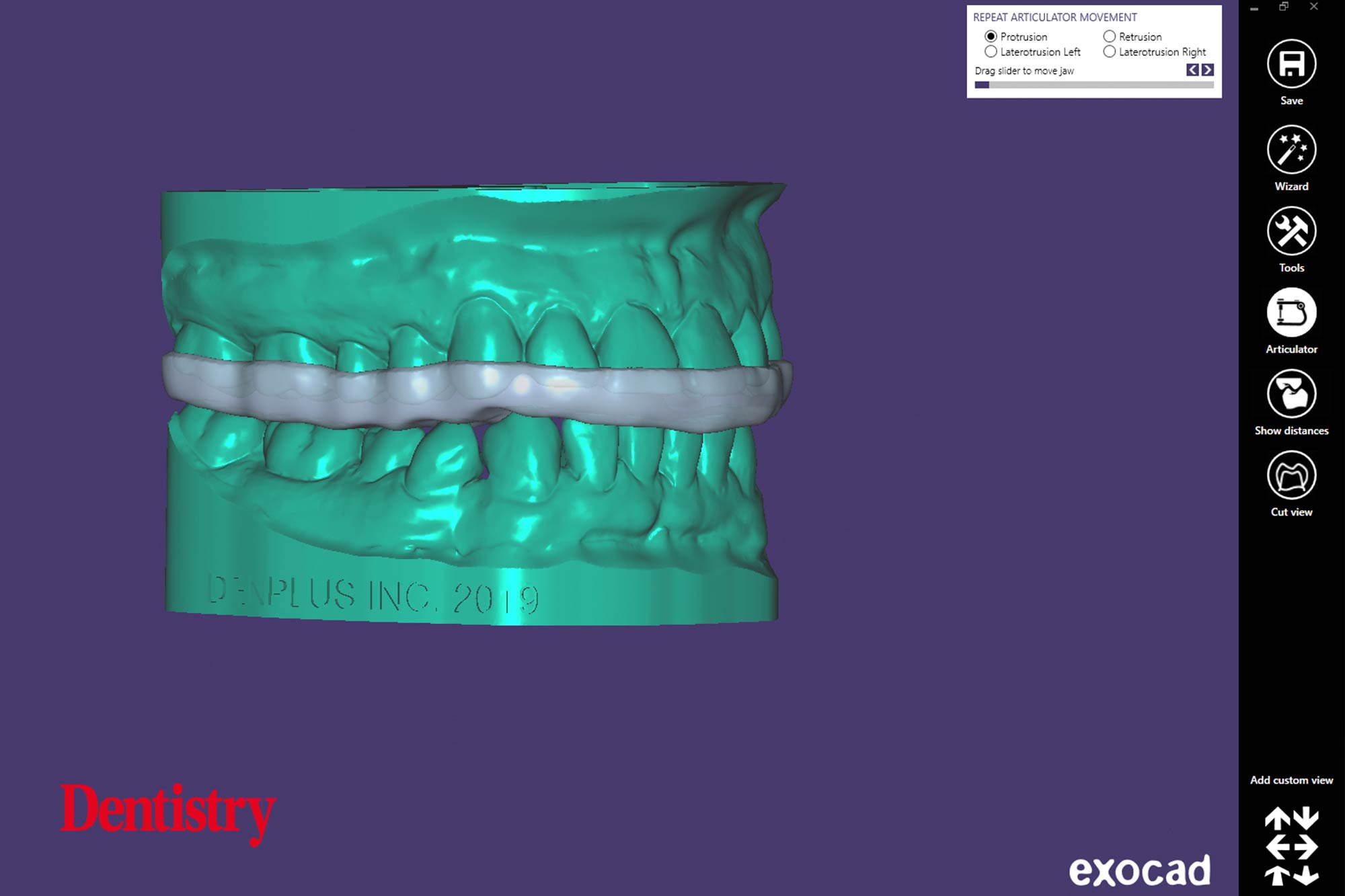 9 Andre Andre Gaul RDT gives a step-by-step overview of the design and fabrication process of printed occlusal splints.