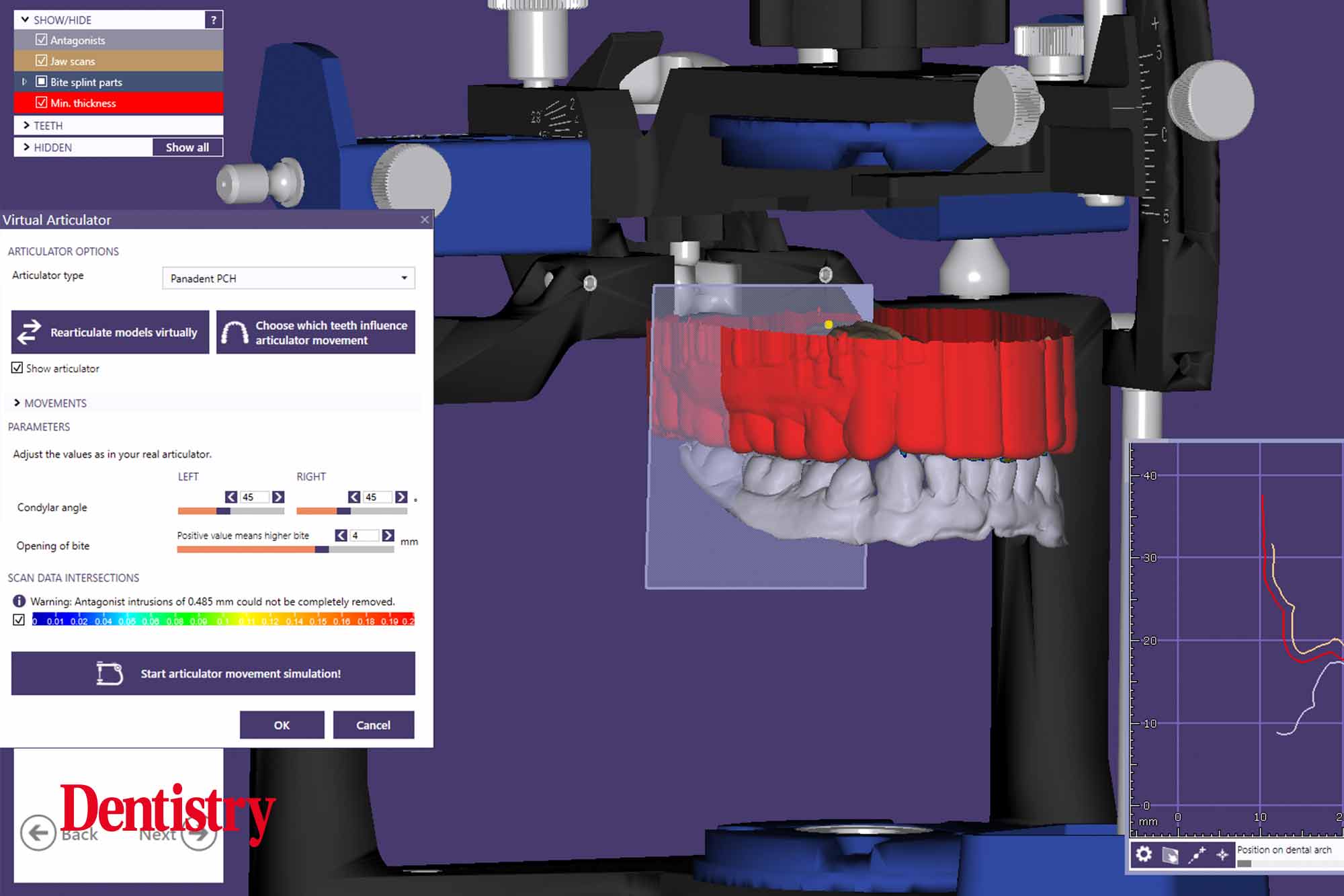 6 Andre Andre Gaul RDT gives a step-by-step overview of the design and fabrication process of printed occlusal splints.