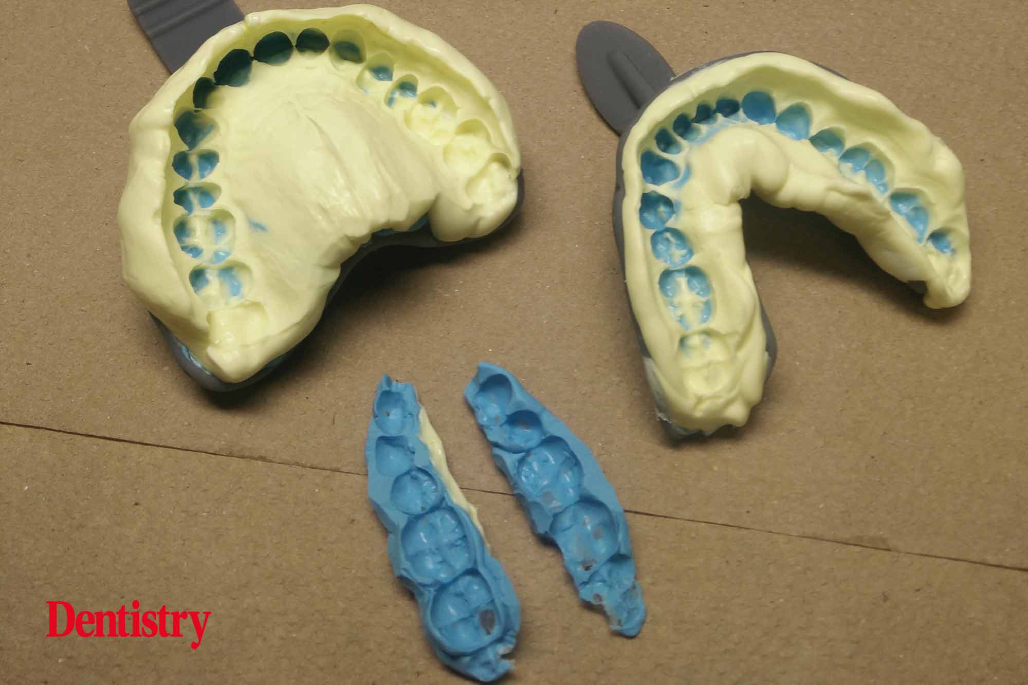 1 Andre Andre Gaul RDT gives a step-by-step overview of the design and fabrication process of printed occlusal splints.