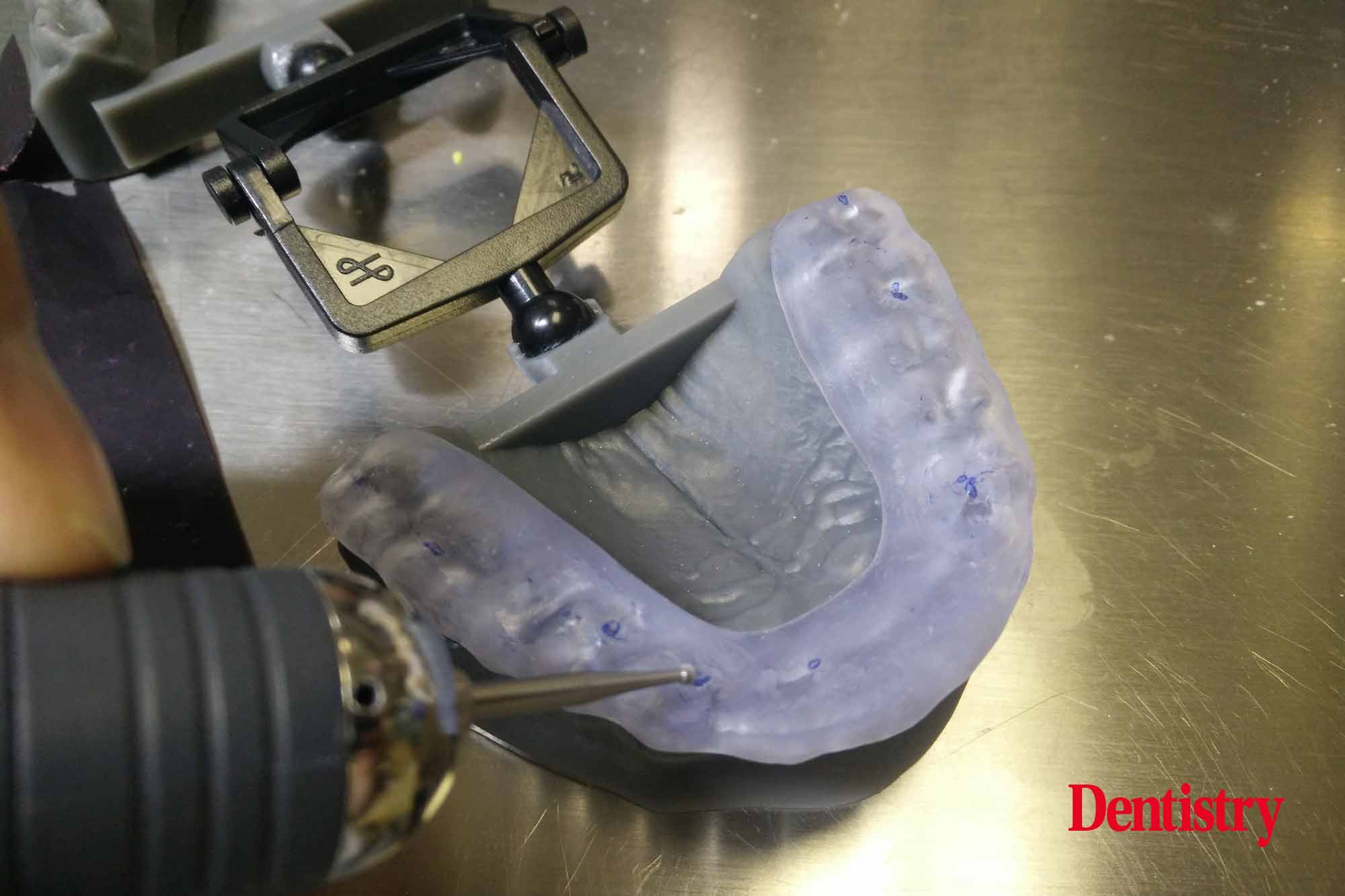 andre-19 Andre Gaul RDT gives a step-by-step overview of the design and fabrication process of printed occlusal splints.
