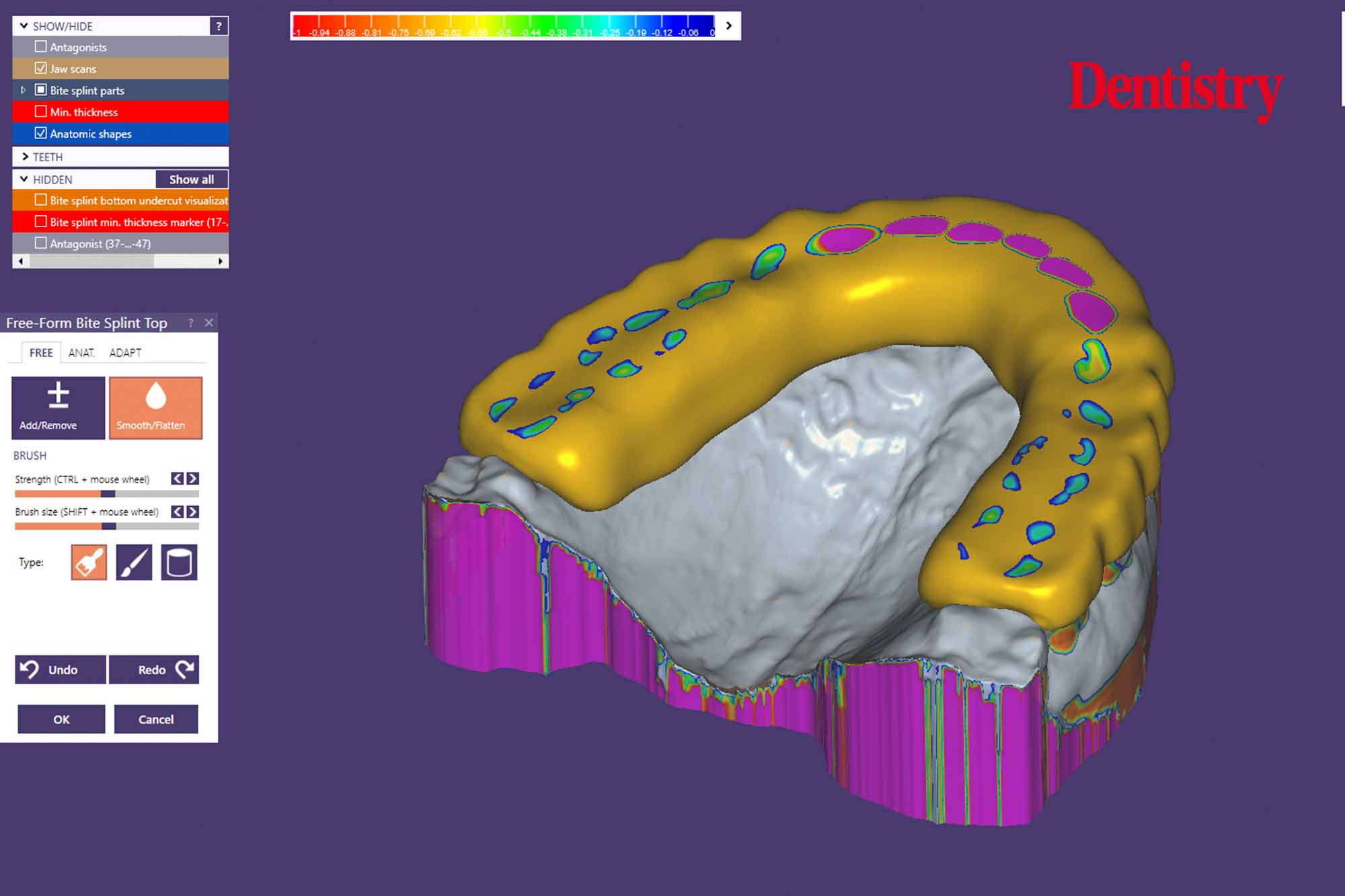 7 Andre Andre Gaul RDT gives a step-by-step overview of the design and fabrication process of printed occlusal splints.