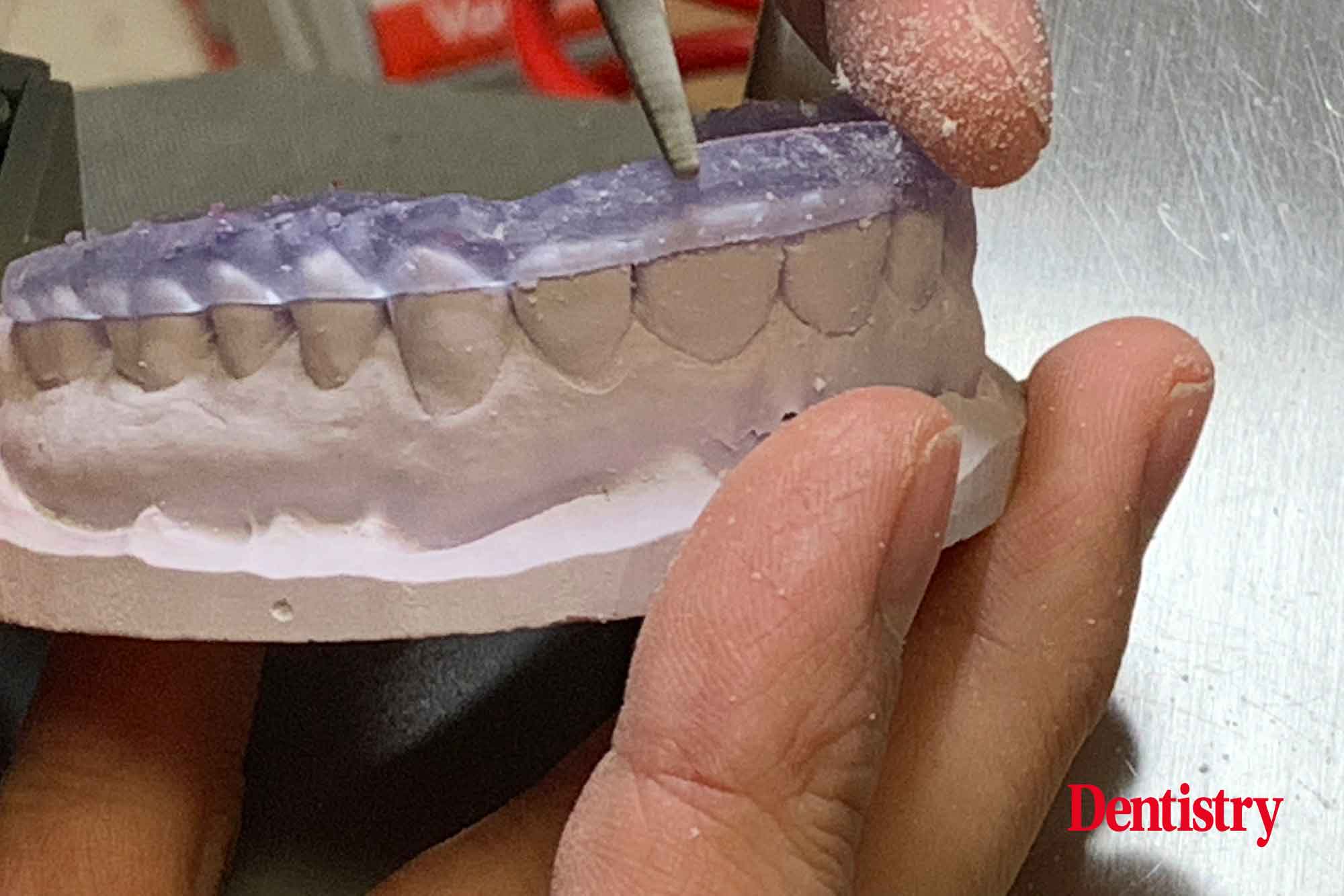 fig-15 Andre Gaul RDT gives a step-by-step overview of the design and fabrication process of printed occlusal splints.