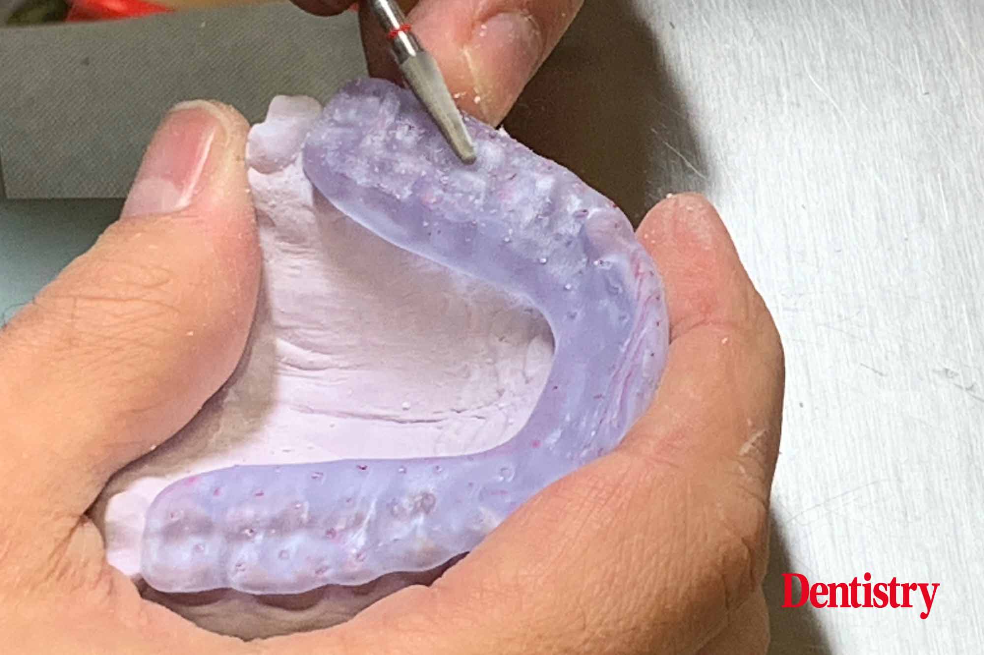 fig-16 Andre Gaul RDT gives a step-by-step overview of the design and fabrication process of printed occlusal splints.