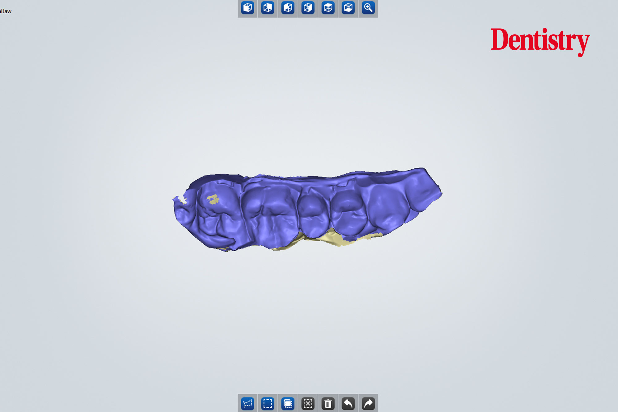 4 Andre Andre Gaul RDT gives a step-by-step overview of the design and fabrication process of printed occlusal splints.