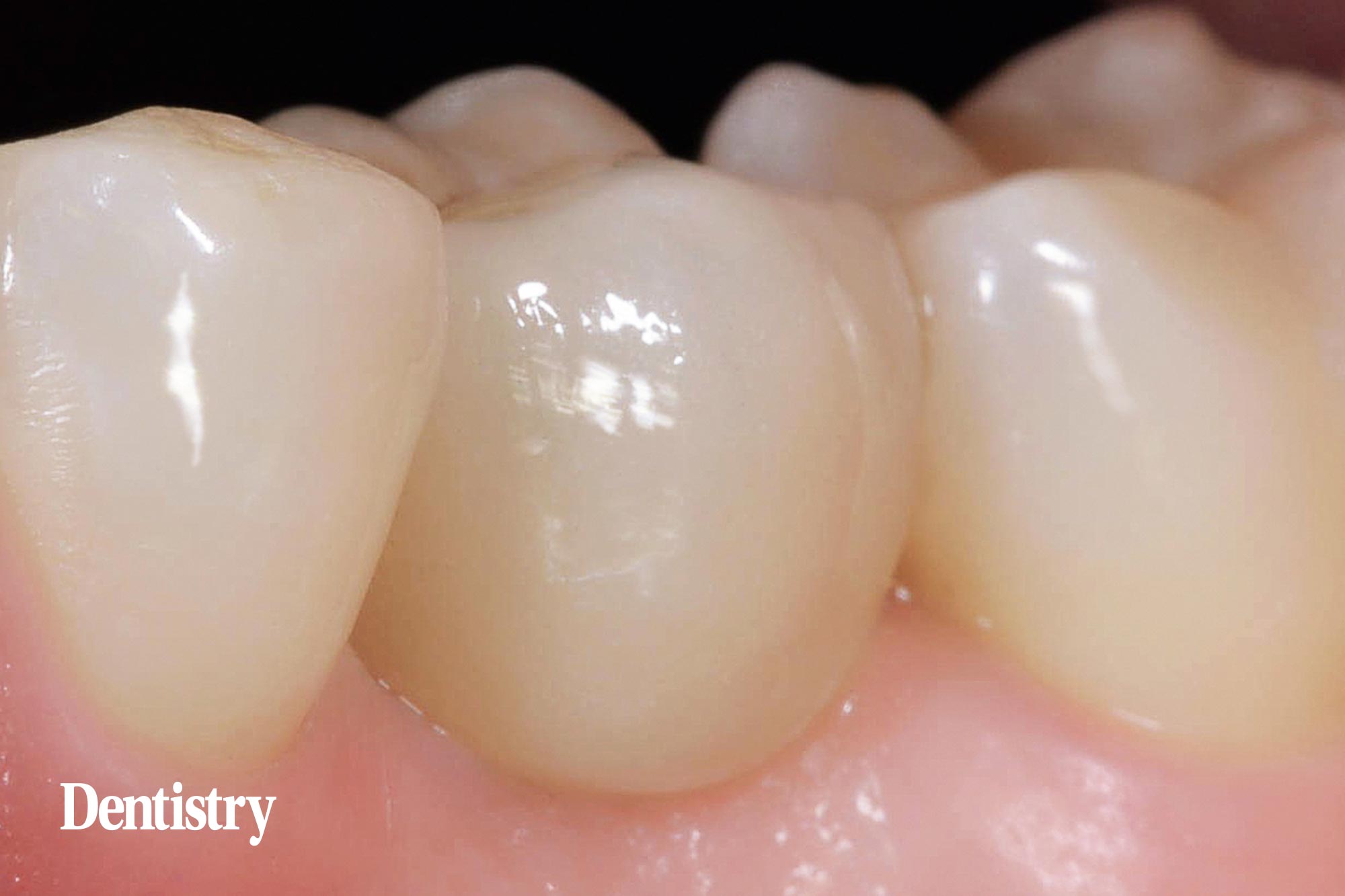 10 Mauro Fazioni and Andrea Lombardo discuss the importance of making implants with toothlike restoration materials and how you can do this.