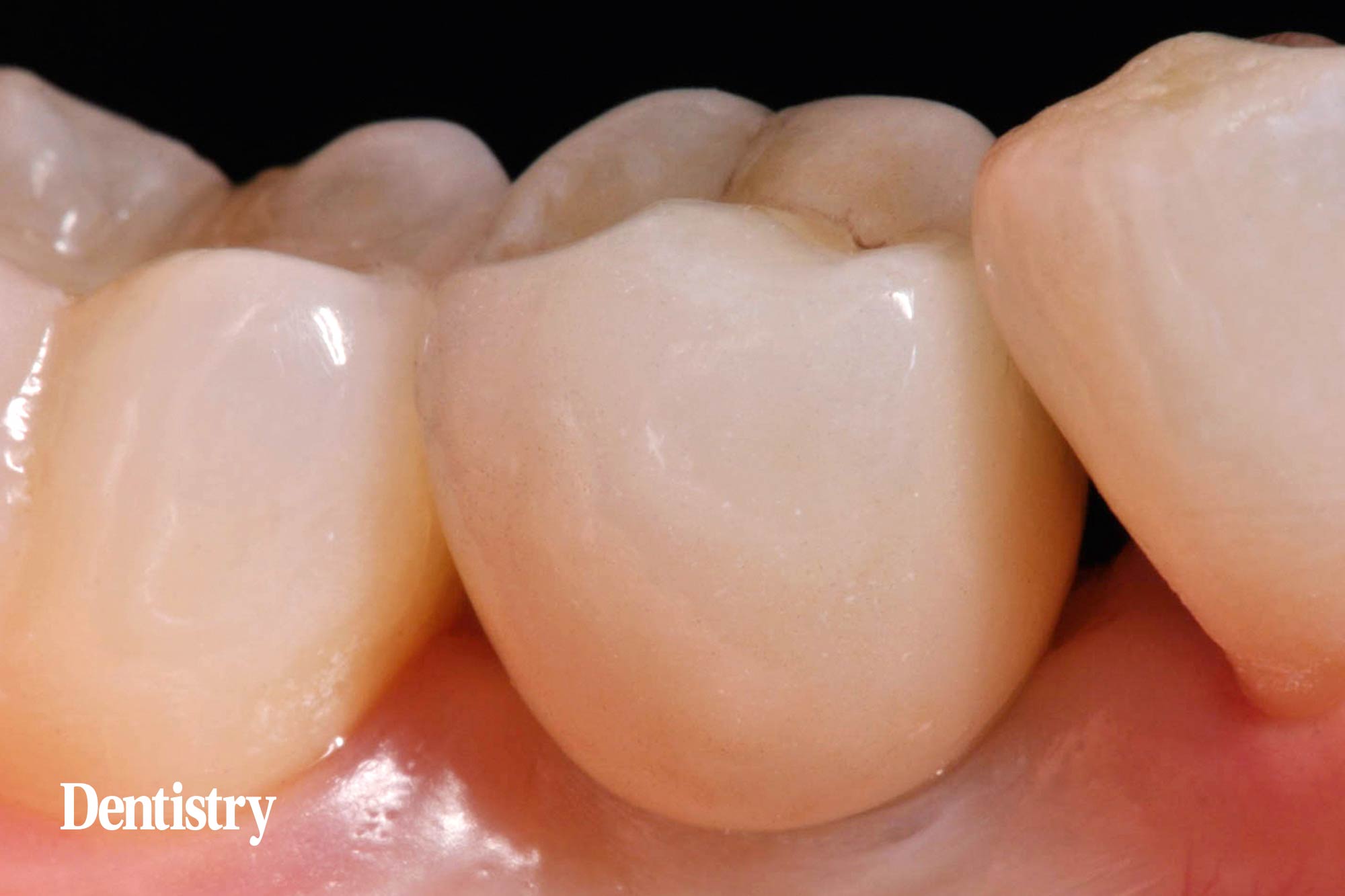 11 Mauro Fazioni and Andrea Lombardo discuss the importance of making implants with toothlike restoration materials and how you can do this.