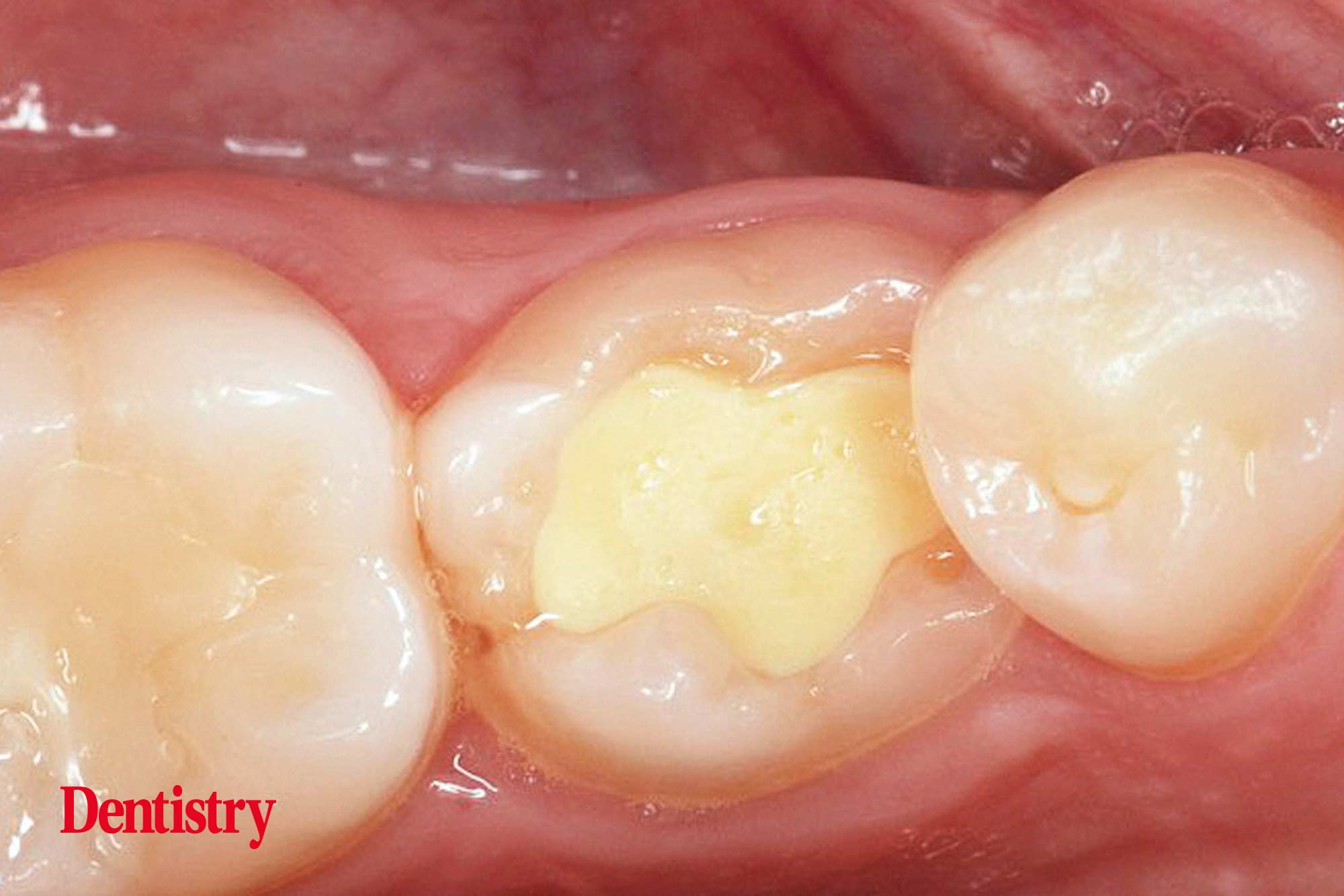 1a Mauro Fazioni and Andrea Lombardo discuss the importance of making implants with toothlike restoration materials and how you can do this.