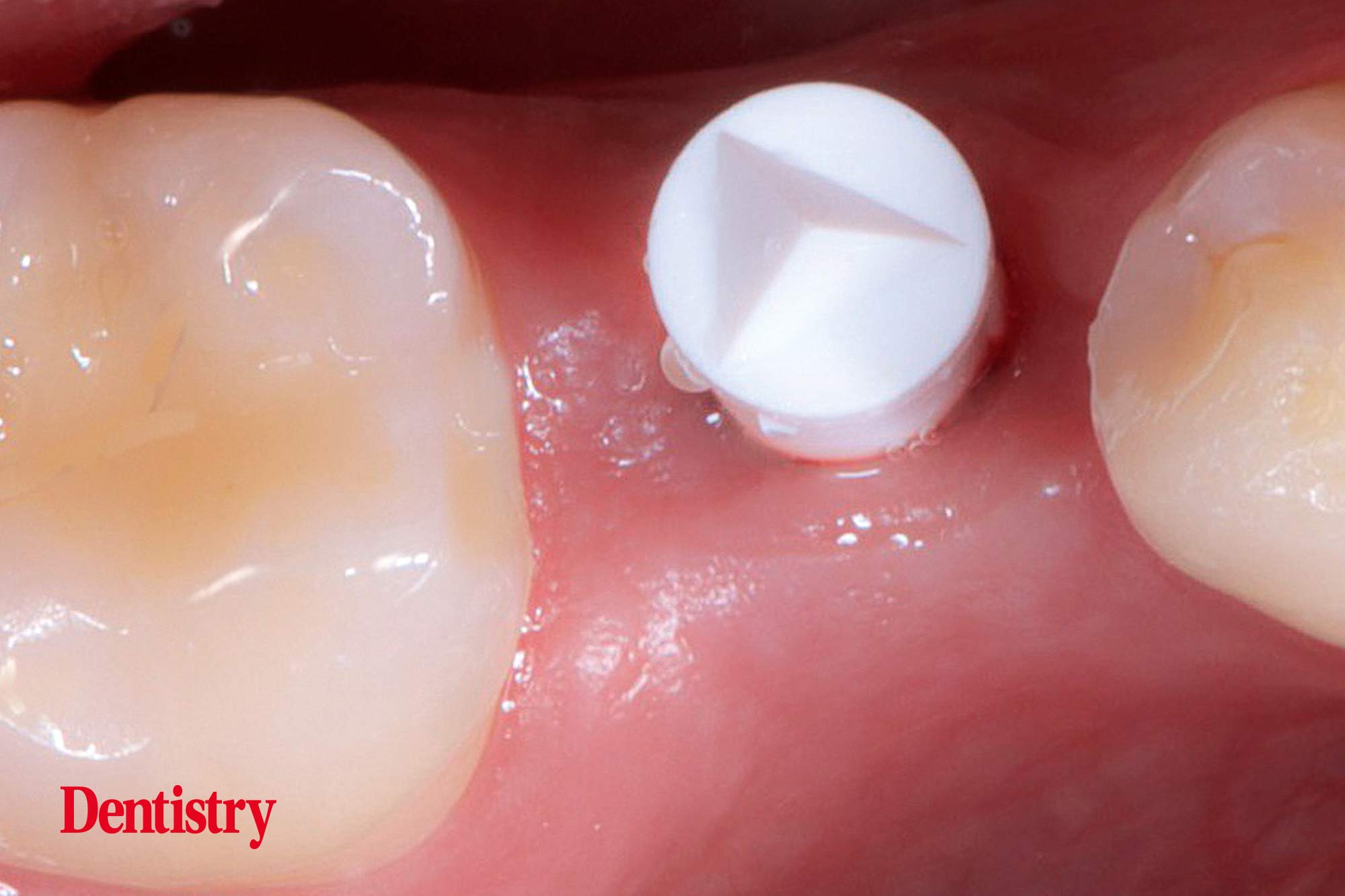 2b Mauro Fazioni and Andrea Lombardo discuss the importance of making implants with toothlike restoration materials and how you can do this.