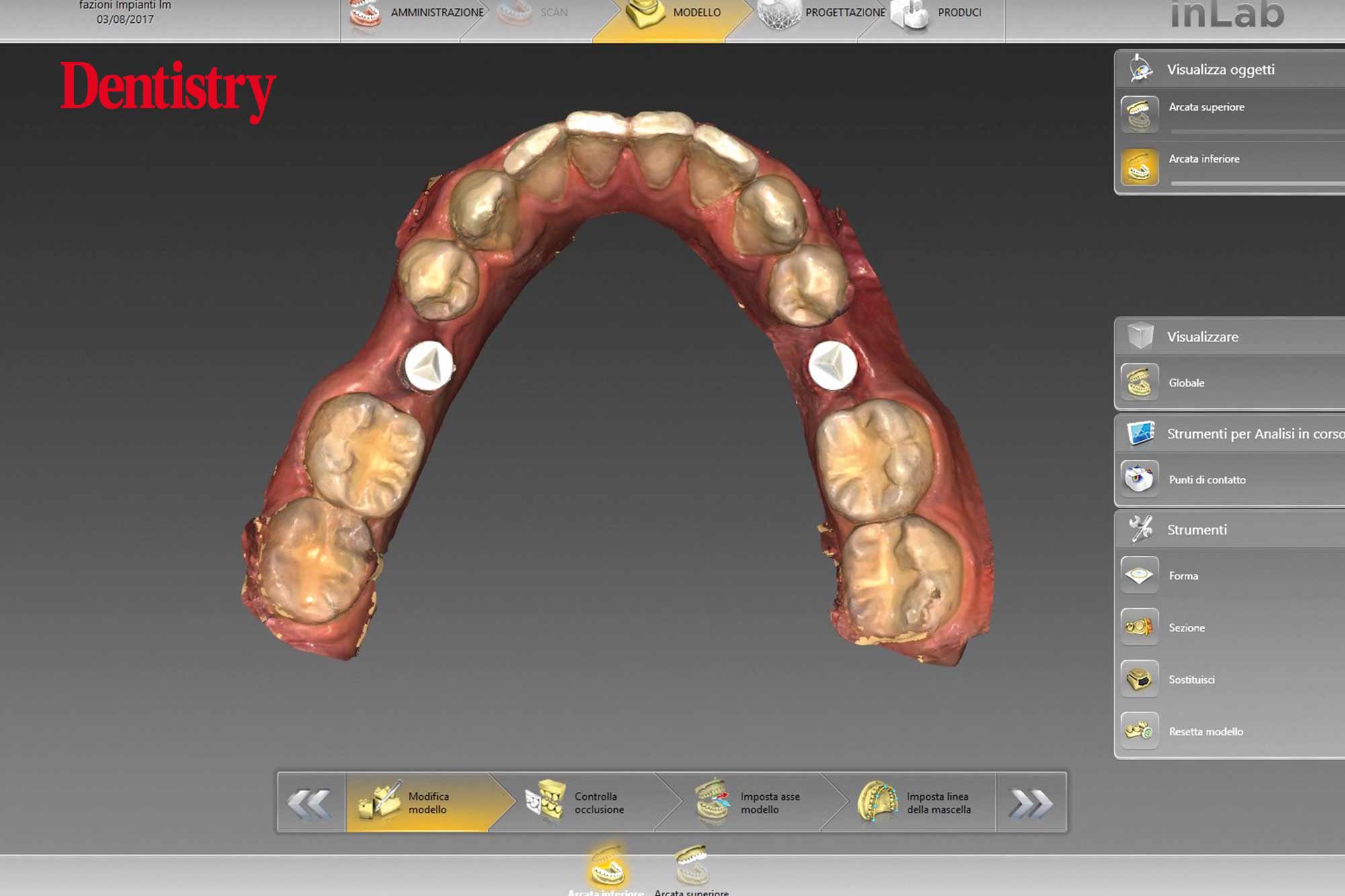 3 Mauro Fazioni and Andrea Lombardo discuss the importance of making implants with toothlike restoration materials and how you can do this.