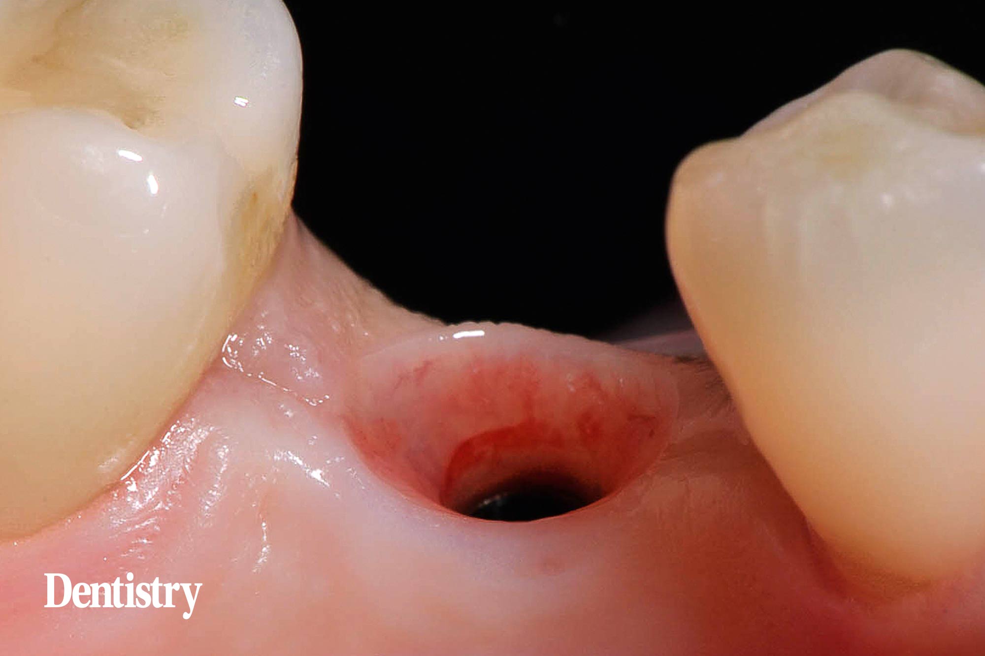 6 Mauro Fazioni and Andrea Lombardo discuss the importance of making implants with toothlike restoration materials and how you can do this.