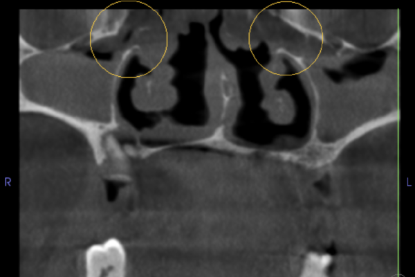 Coronal section through both maxillary sinus ostia (circles in image). Both sinus ostia are full of soft tissue and appear to be widened. The posterior portions of the sinuses are almost completely full of soft tissue although there is no displacement or erosion of the sinus walls