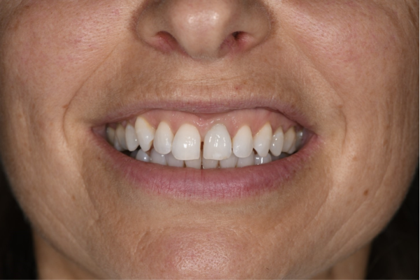 A difficult clinical situation with a high smile line, patient with high expectations and a failing upper left central incisor
