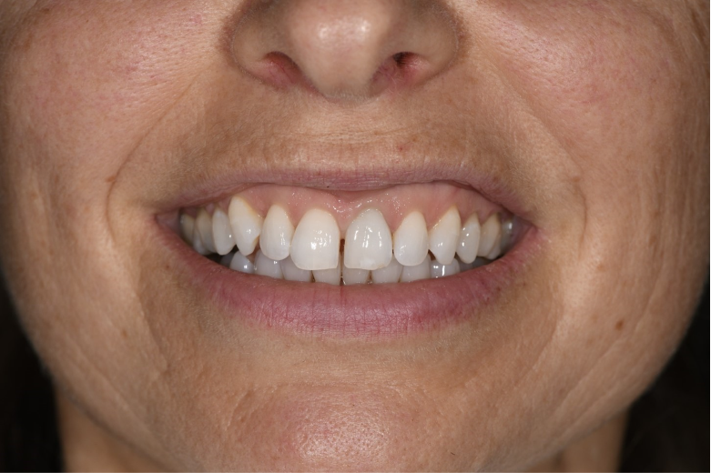 difficult A difficult clinical situation with a high smile line, patient with high expectations and a failing upper left central incisor