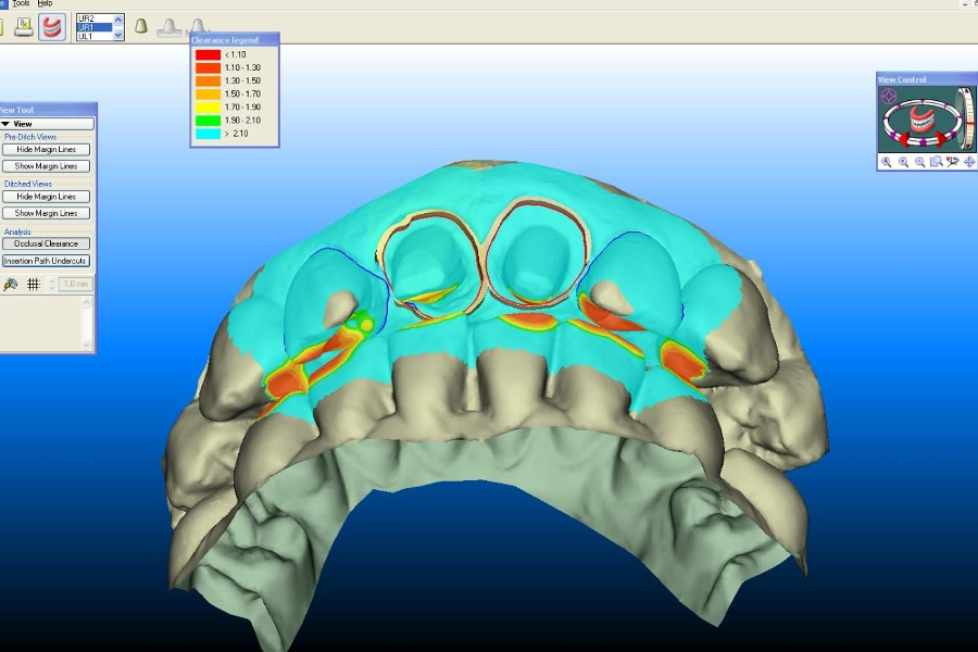 intraoral scan