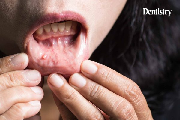State of mouth cancer UK report