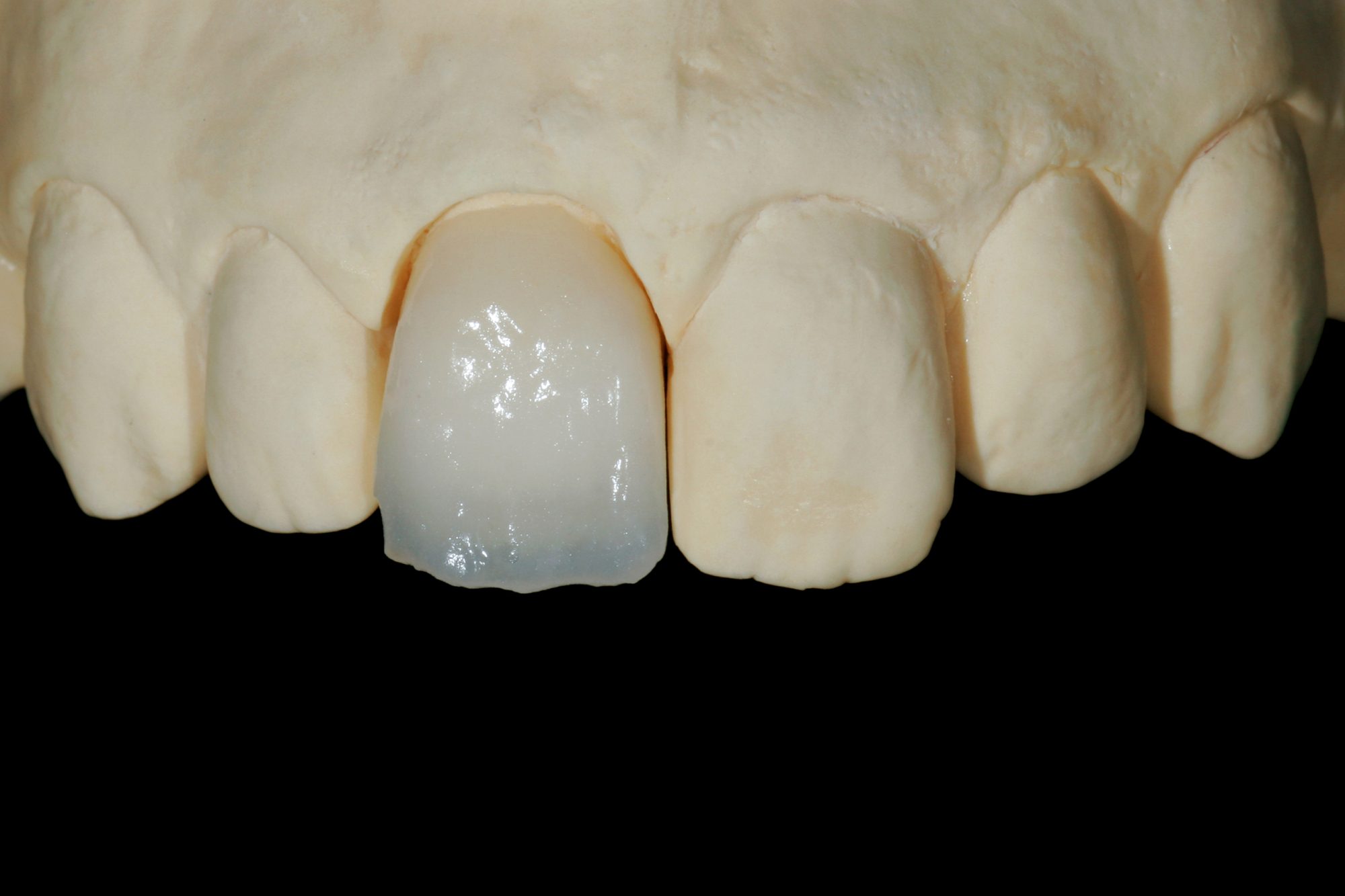 Ceramic Crown_013c