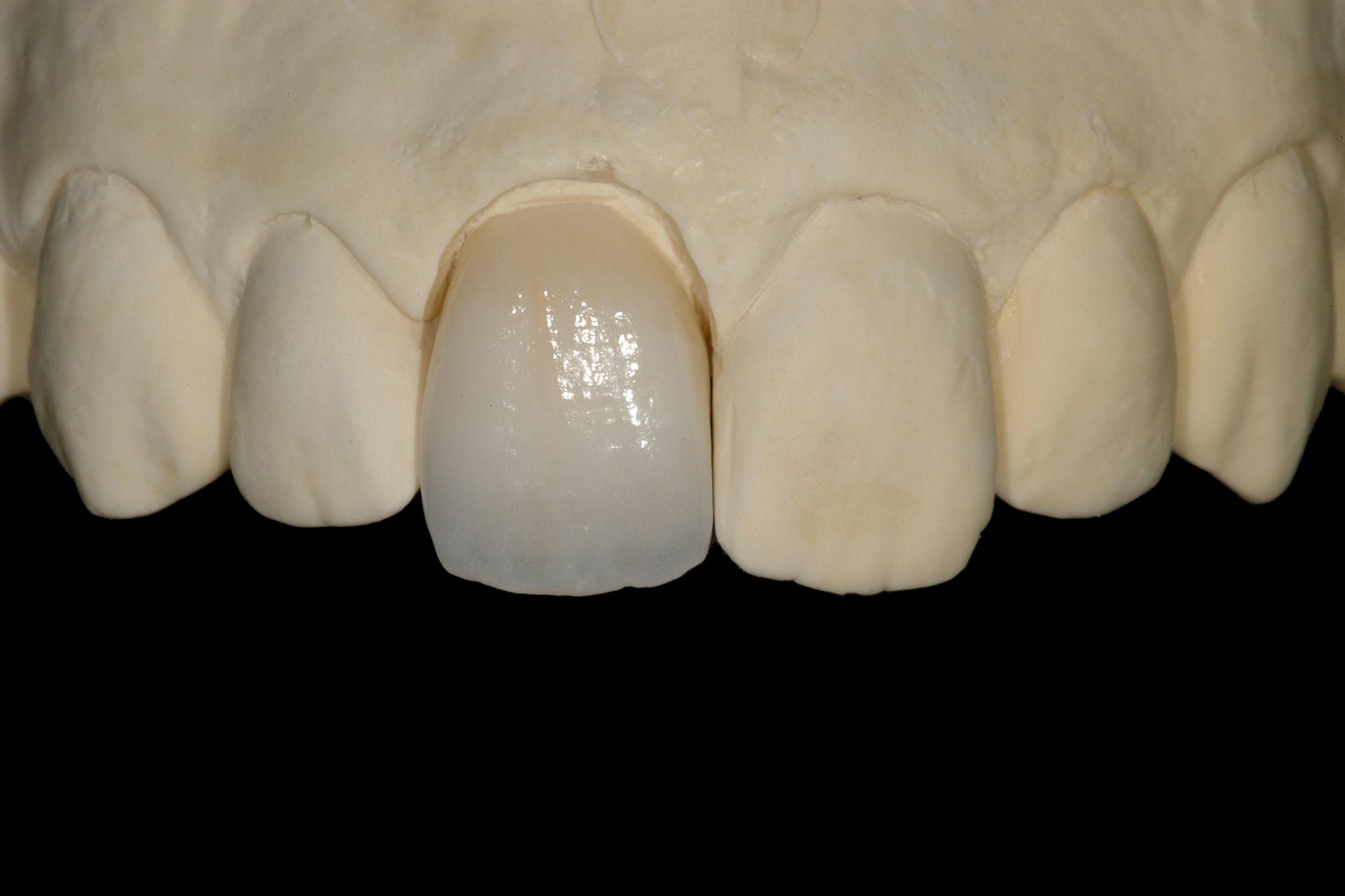 Ceramic Crown_013d