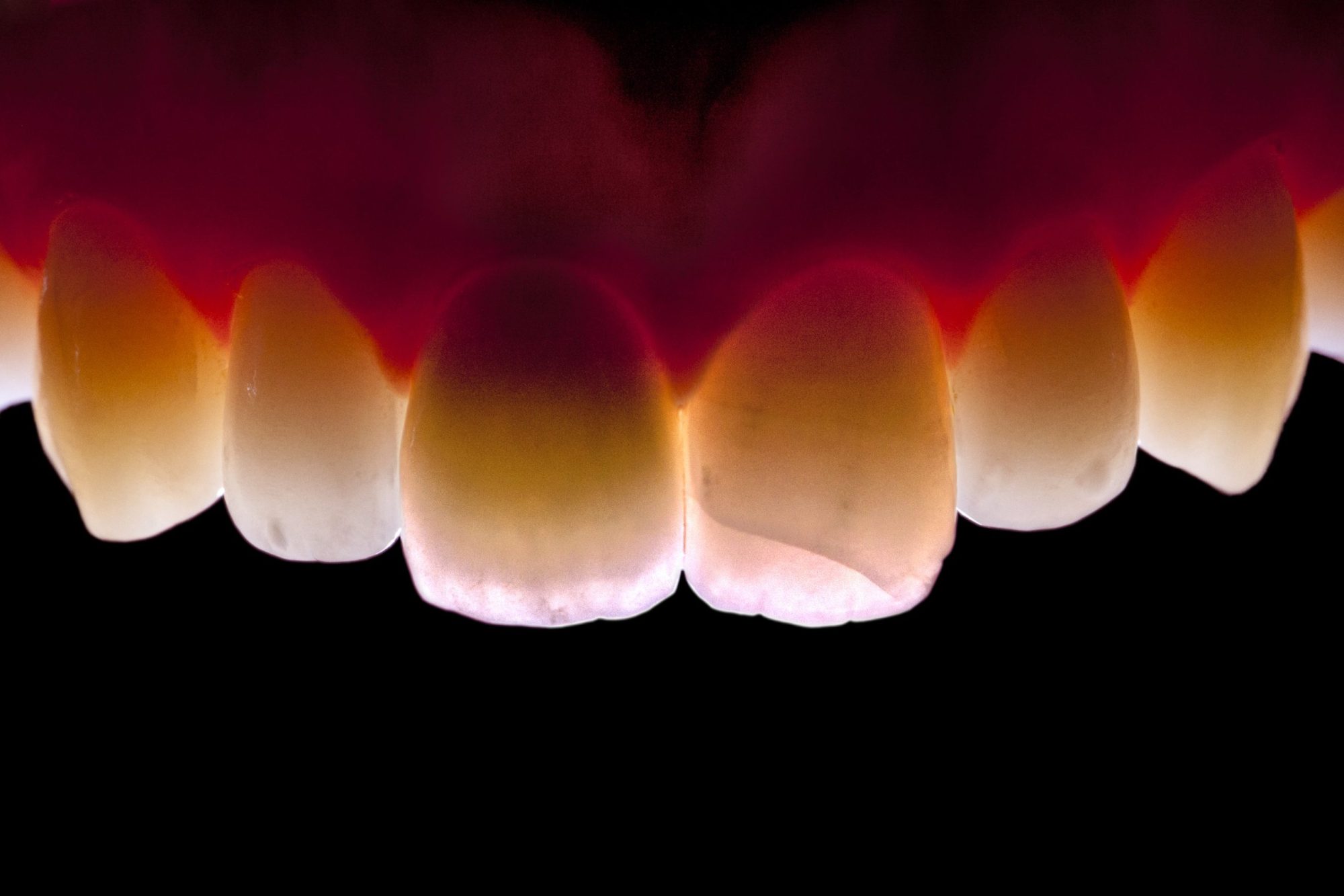 Ceramic Crown_022 Figure 22: Excellent light transmittance capacity of the ceramic crown, indistinguishable from the neighbouring dentition