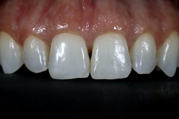 Nishan Dixit describes a minimally invasive alignment, bleaching and edge-bonding case in which the patient was ‘elated and confident’ after their smile transformation.