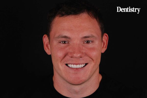 Avant Garde smile makeover