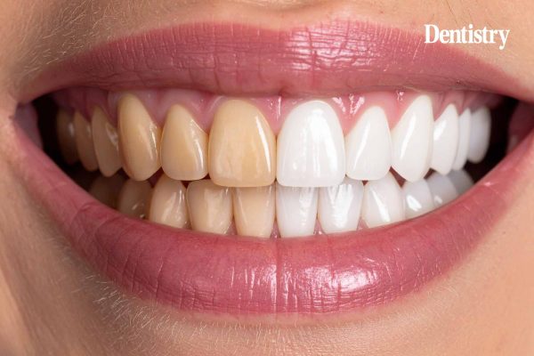 Even tooth colour 'more important to patients than white smile'