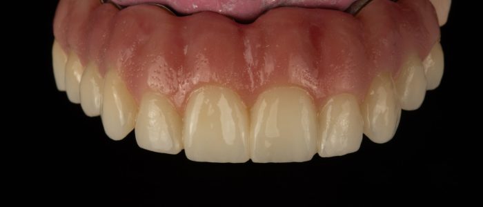 Freudenthal case3e