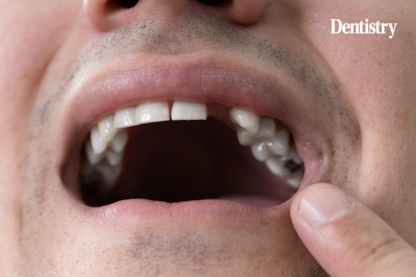 Toregem tooth regeneration Kyoto